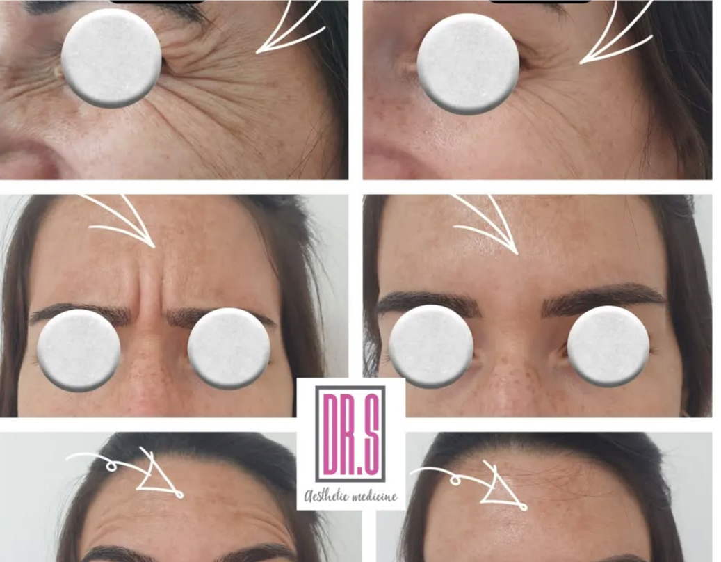 מילוי קמטים ובוטוקס